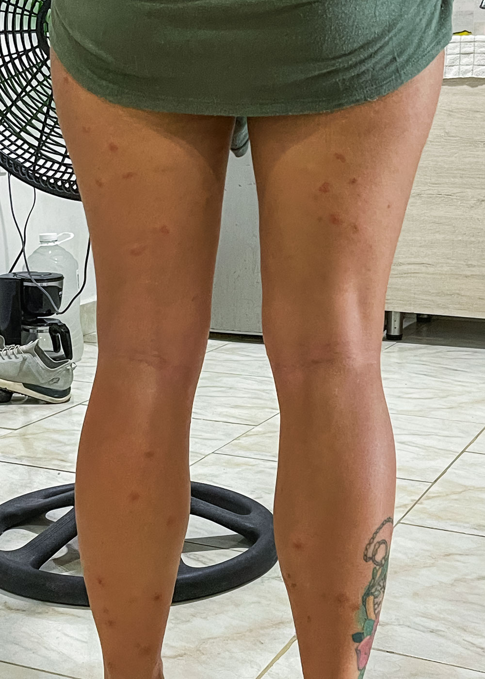 Multiple mosquito bites covering both of Sara's legs.