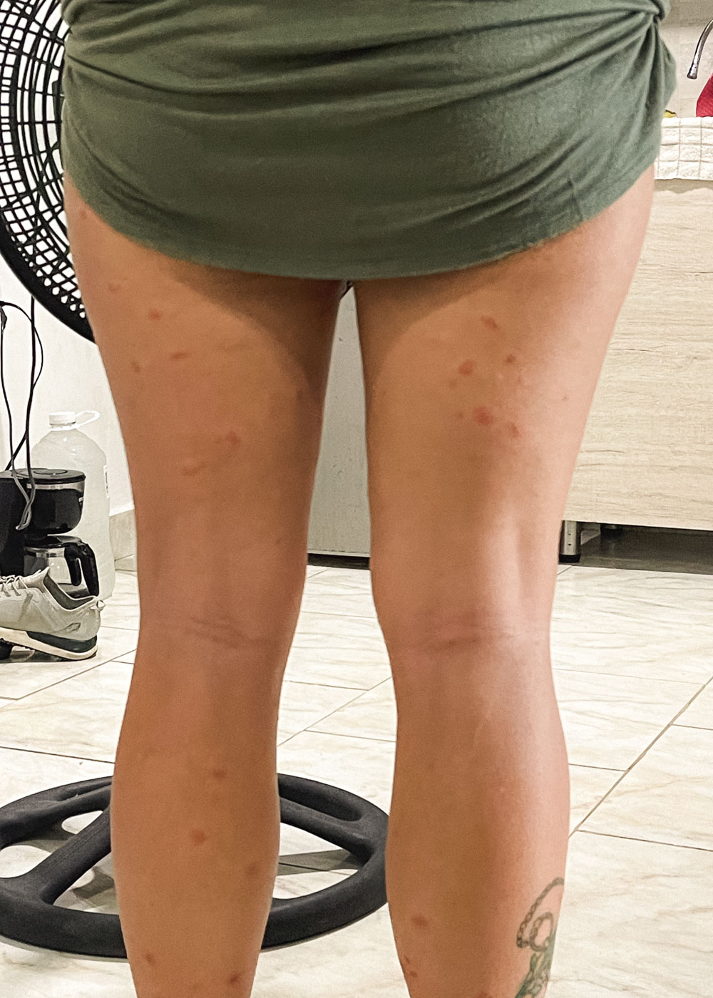 Sara holding up her green dress and showing off her many mosquito bites on her legs.